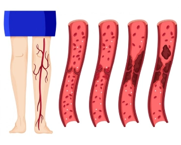Peripheral Artery Disease Treatment 1 Peripheral Artery Disease
