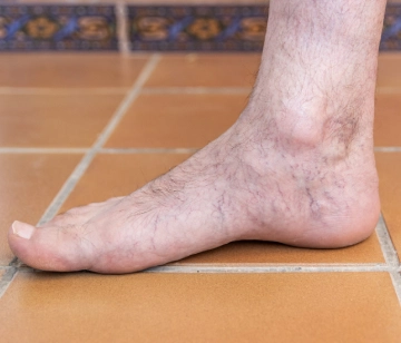 Peripheral Artery Disease Treatment 12 What is Peripheral Artery Disease?