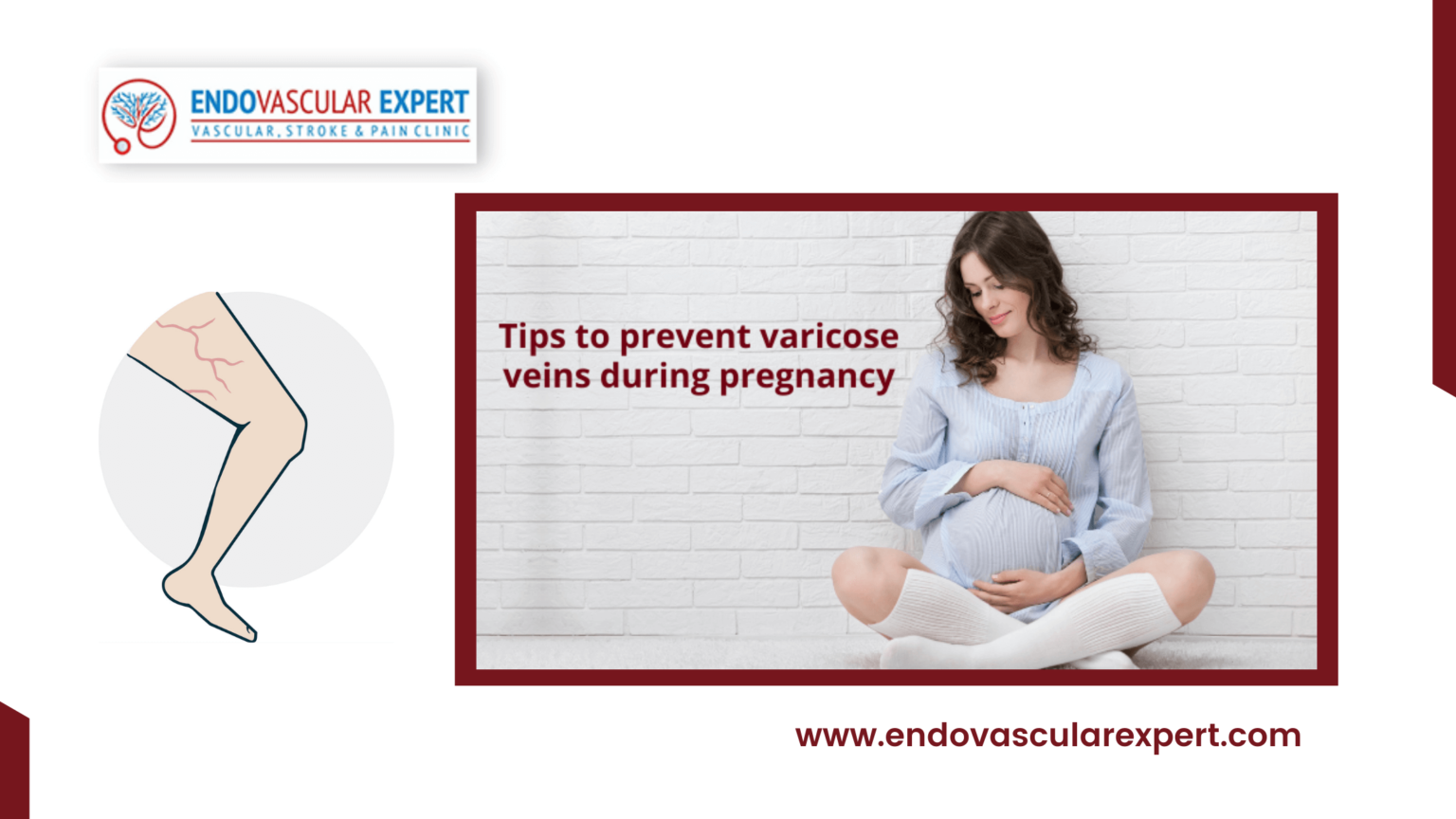 [2022] Prevention Of Varicose Veins During Pregnancy? Endovascular