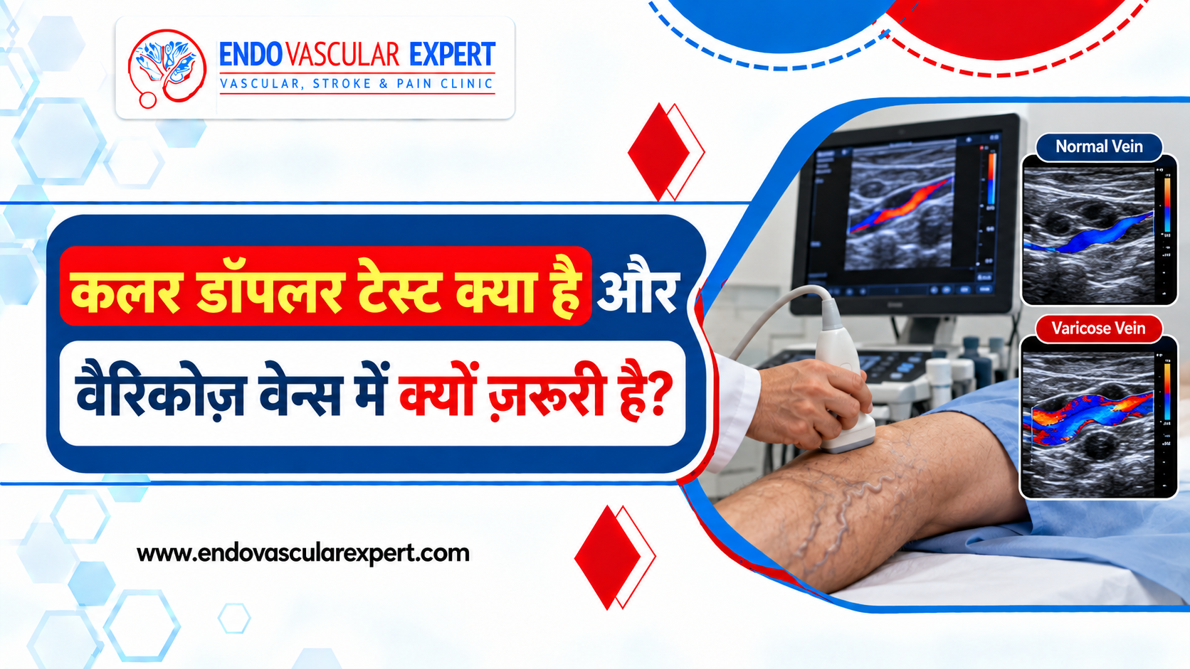 कलर डॉपलर टेस्ट क्या है और वैरिकोज़ वेन्स में क्यों ज़रूरी है? 2 कलर डॉपलर टेस्ट