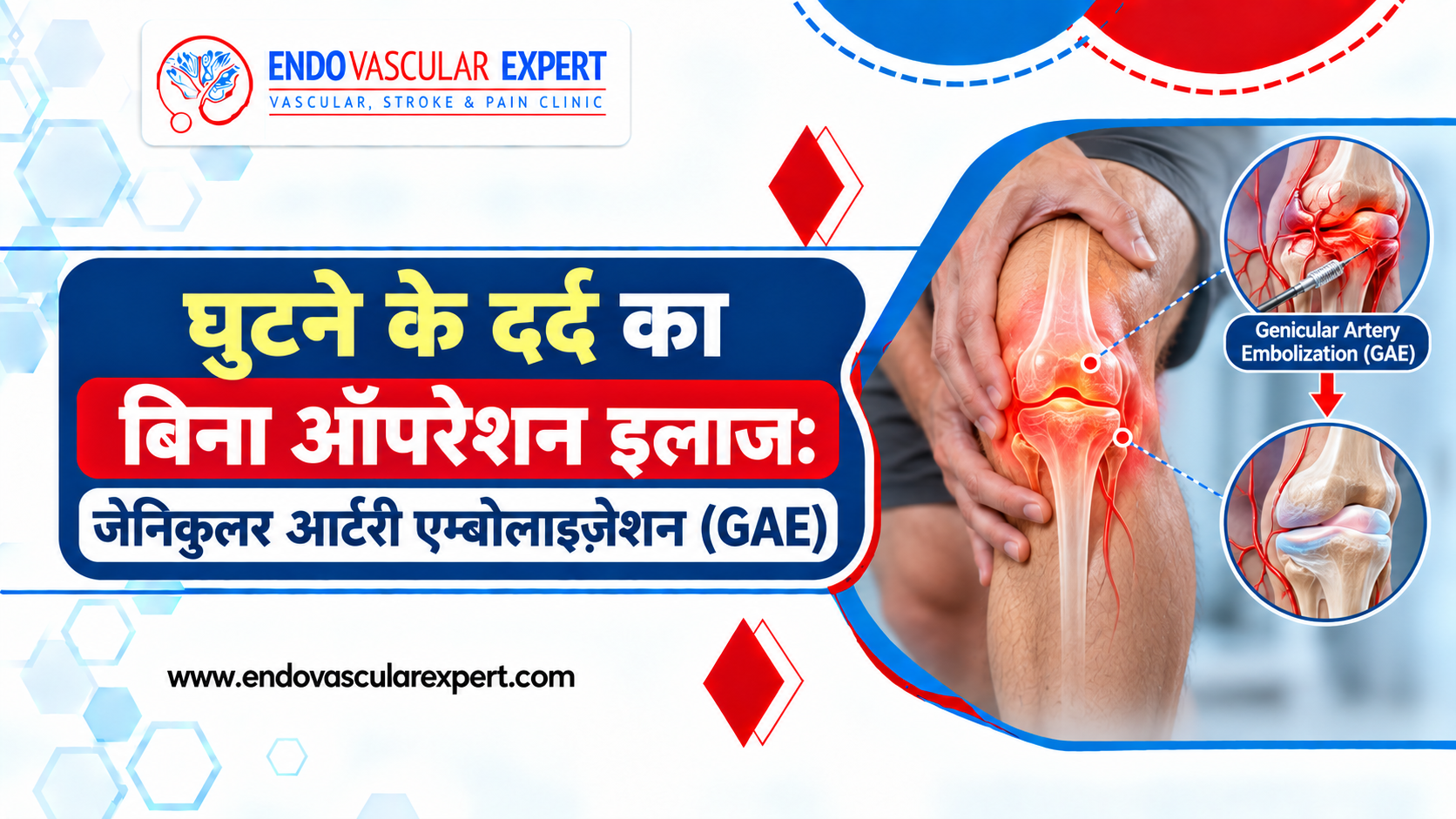 घुटने के दर्द का बिना ऑपरेशन इलाज: जेनिकुलर आर्टरी एम्बोलाइज़ेशन (GAE) 2 घुटने के दर्द का बिना ऑपरेशन इलाज