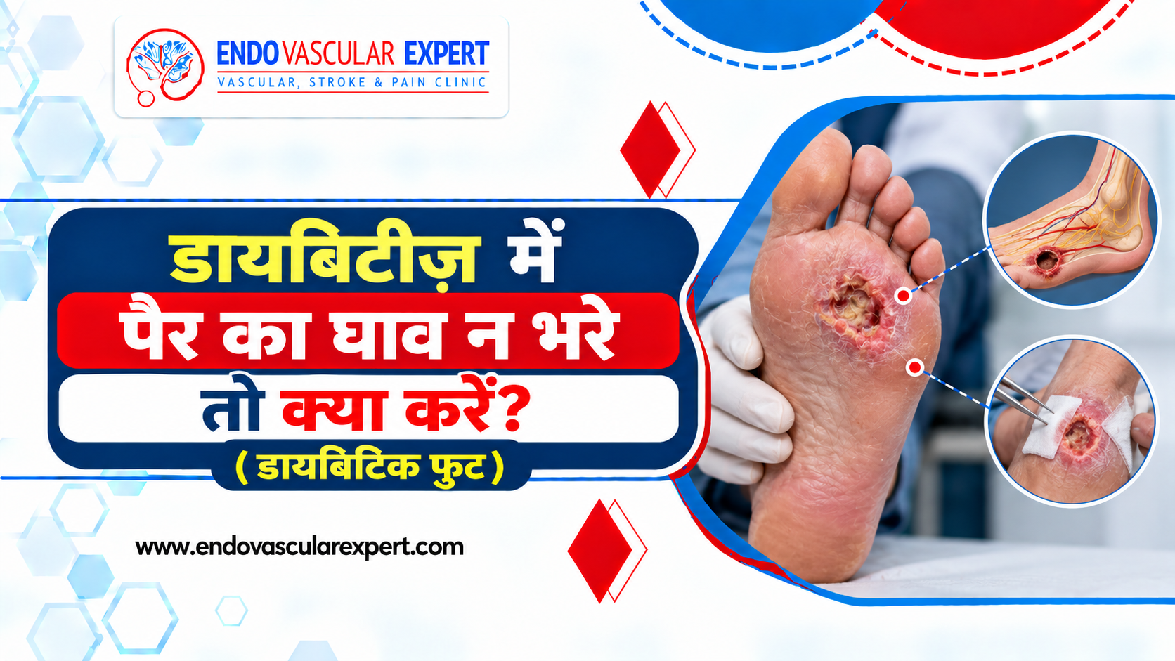 डायबिटीज़ में पैर का घाव न भरे तो क्या करें? (डायबिटिक फुट) 2 डायबिटीज़ में पैर का घाव