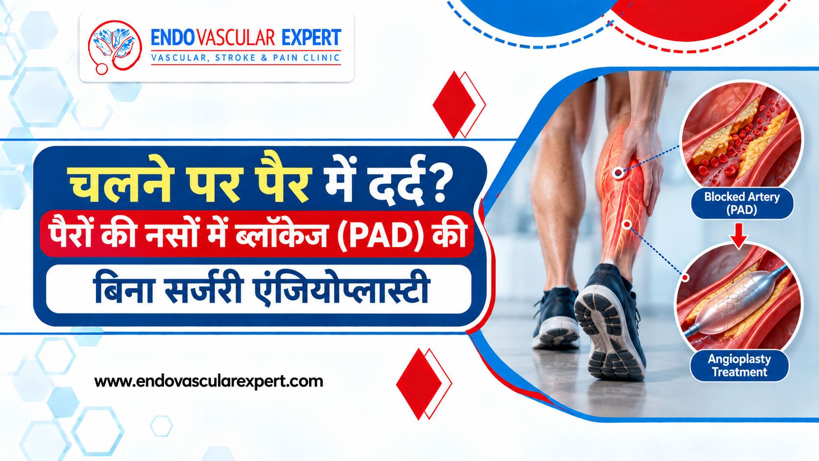 चलने पर पैर में दर्द? पैरों की नसों में ब्लॉकेज (PAD) की बिना सर्जरी एंजियोप्लास्टी 2 पैरों की नसों में ब्लॉकेज