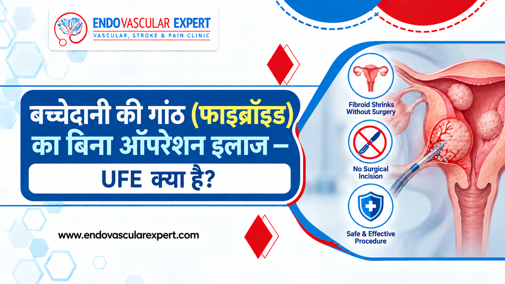 बच्चेदानी की गांठ (फाइब्रॉइड) का बिना ऑपरेशन इलाज — UFE क्या है? 2 बच्चेदानी की गांठ (फाइब्रॉइड) का बिना ऑपरेशन इलाज