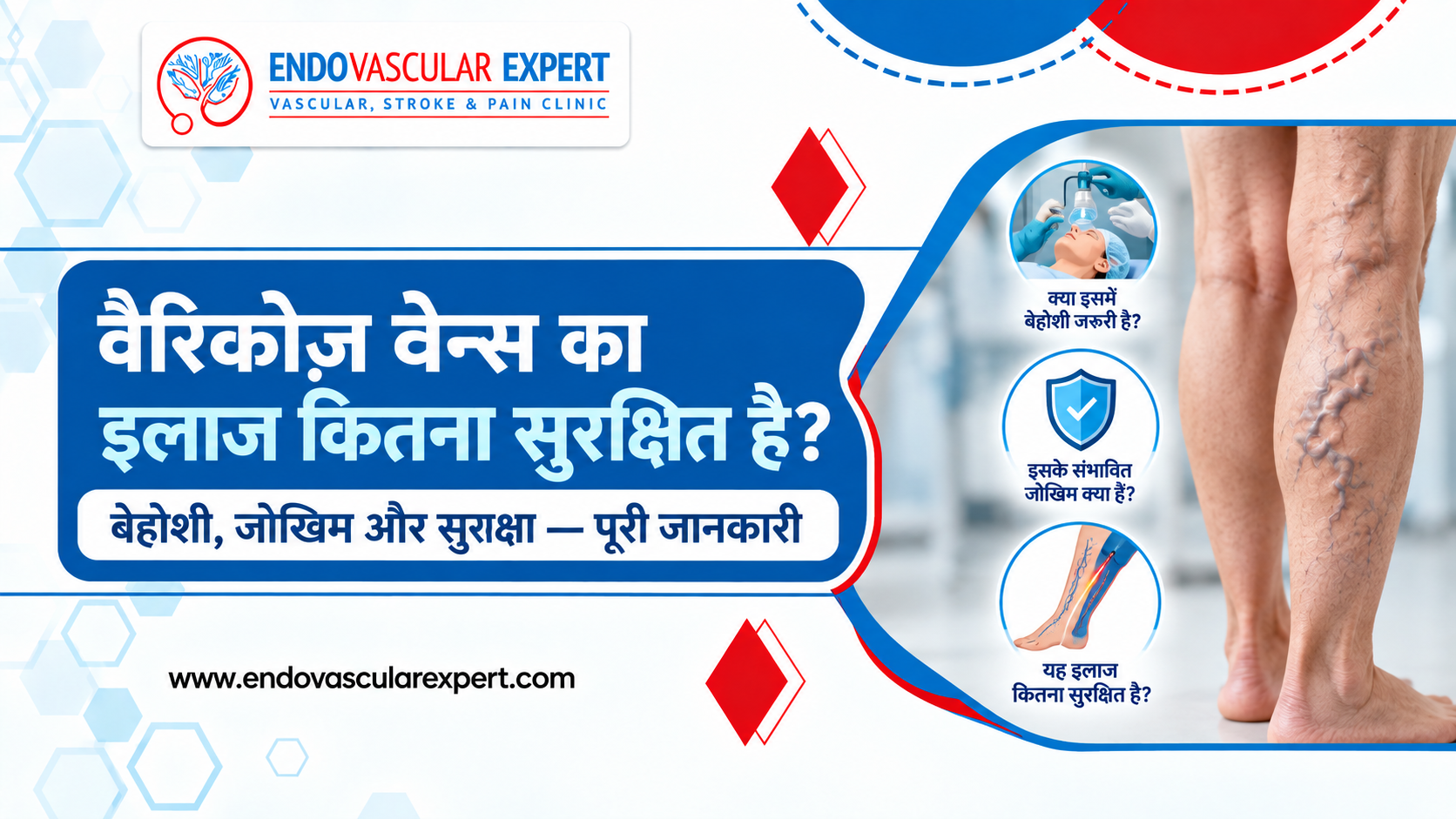 वैरिकोज़ वेन्स का इलाज कितना सुरक्षित है? बेहोशी, जोखिम और सुरक्षा — पूरी जानकारी 2 वैरिकोज़ वेन्स का इलाज