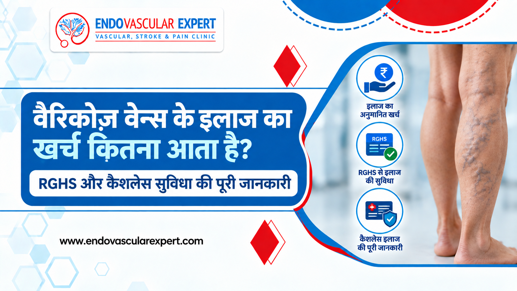 वैरिकोज़ वेन्स के इलाज का खर्च कितना आता है? RGHS और कैशलेस सुविधा की पूरी जानकारी 2 वैरिकोज़ वेन्स के इलाज का खर्च