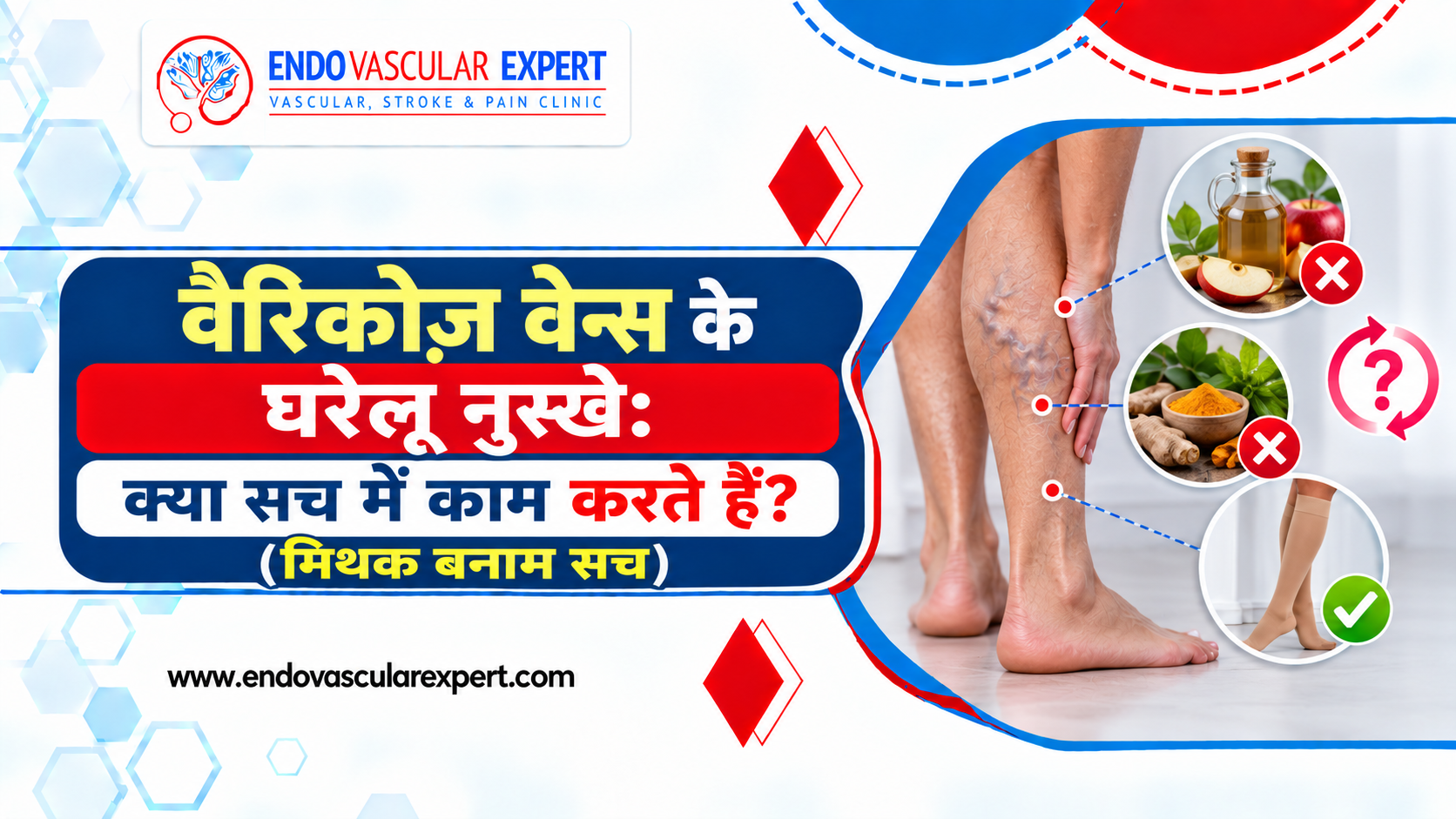 वैरिकोज़ वेन्स के घरेलू नुस्खे: क्या सच में काम करते हैं? (मिथक बनाम सच) 2 वैरिकोज़ वेन्स के घरेलू नुस्खे